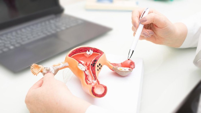 a person holding a pen over a model of the uterus